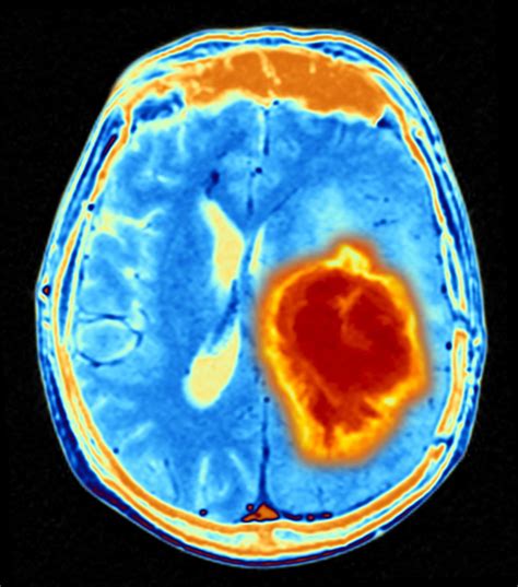 Glioma Target Identified that Improves Immunotherapy in Mice