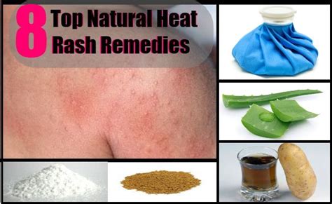 1000+ images about Heat Rash! on Pinterest | Cure Yeast Infection, Urticaria and Skin Problems