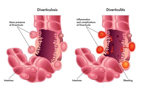 Gastroenterologists In Florida | Diverticular Disease ...