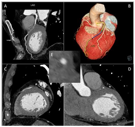 JCM | Free Full-Text | Myocardial Bridging: Review on the Role of ...