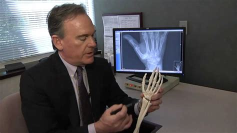 Thumb Arthritis - Carolina Regional Orthopedics