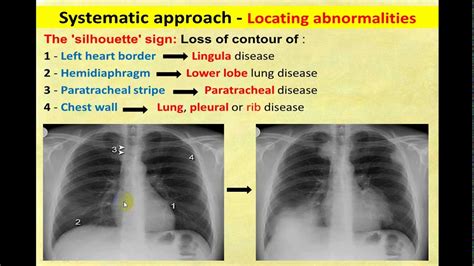 XRAY CHEST SILHOUETTE SIGNS - YouTube