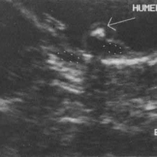 (PDF) Prognosis in Fetal Cystic Hygroma