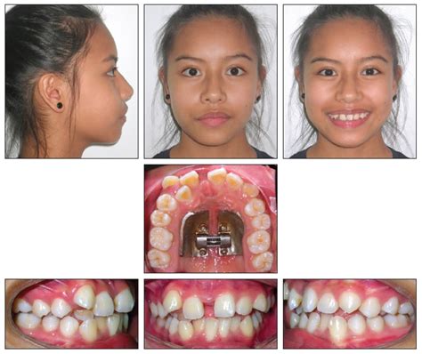 A Tissue- and Boneborne Rapid Palatal Expander - JCO Online - Journal of Clinical Orthodontics