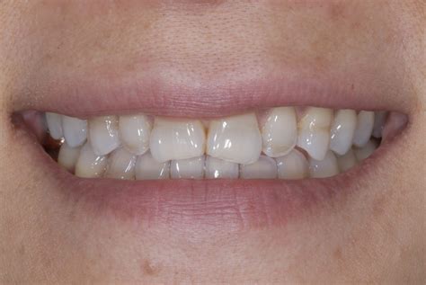 Discolored Teeth | Tetracycline Staining - Tysons Aesthetic Dentistry