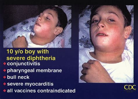 Bull neck Diphtheria – Clinical Case Daily