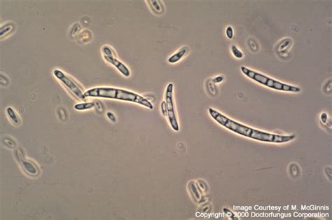 Fusarium species colony and microscopic description | Medical Laboratories