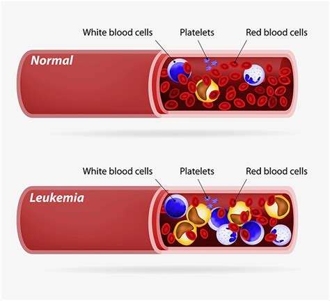 Leukemia Information | Knight Cancer Institute | OHSU