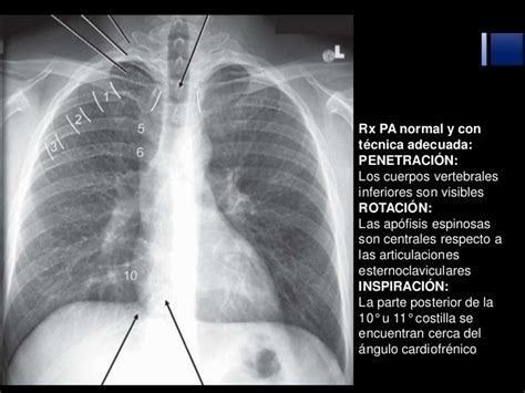 Leer Radiografia De Torax