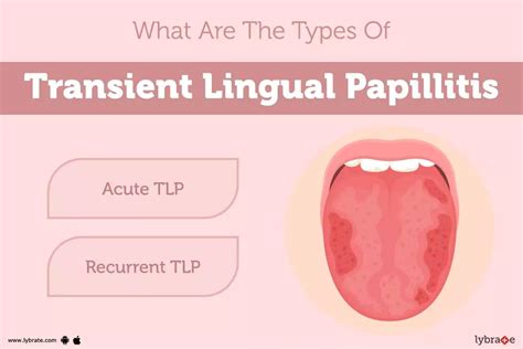 Transient Lingual Papillitis: Causes, Symptoms, Treatment and Cost