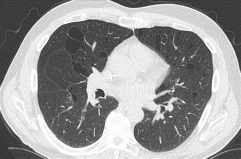 000 Birt Hogg Dube Syndrome | Lungs