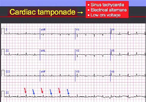 Cardiac tamponade causes, signs, symptoms, diagnosis and treatment