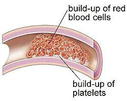 Free For Health: Hypercoagulation (Thick Blood) - Causes, Symptoms and Treatment