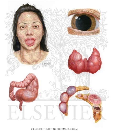 Multiple Endocrine Neoplasia Type 2