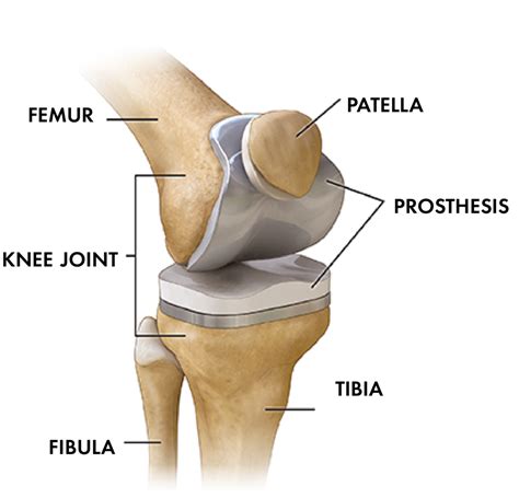 Total Knee Replacement - Orthopedic Specialty Clinic - Spokane, WA