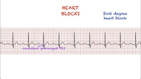 Heart Blocks Interpretation: Easy and Simple - YouTube