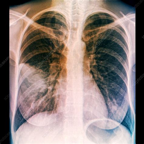 Lungs in pneumonia, X-ray - Stock Image - C029/9955 - Science Photo Library