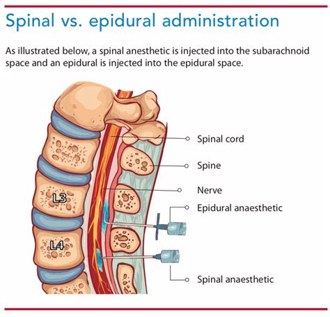 Spinal Block Vs Epidural