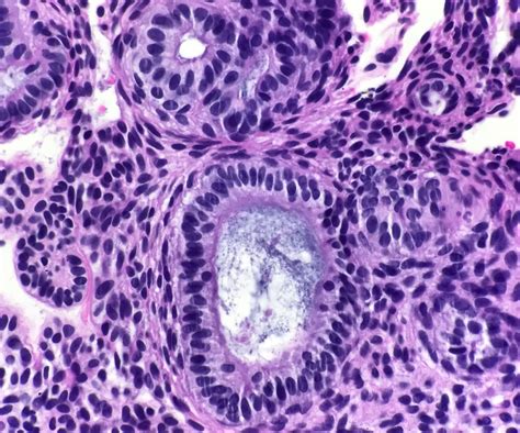 Pathology Outlines - Benign tumors / tumor-like conditions: adenomatoid odontogenic tumor