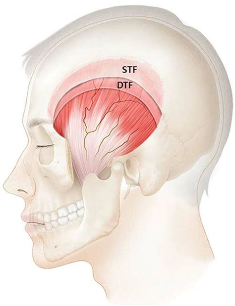 A schematic image showing the temporalis muscle covered by two fasciae ...