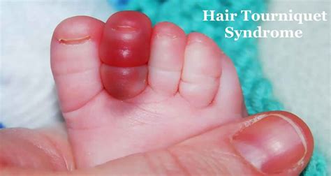 Hair tourniquet syndrome causes, symptoms & treatment