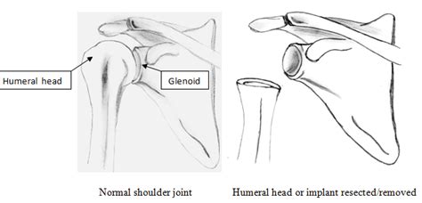 Resection Arthroplasty | Boston Shoulder Institute