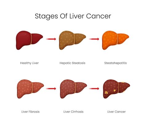 Premium Vector | Stages of liver cancer illustration