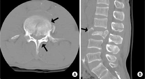 Axial (A) and sagittal (B) CT scans show L3 burst fracture with ...