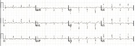 Biphasic T waves in V3, V4, V5, V6 derivations on the ...