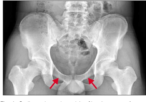 Superior Pubic Ramus Fracture