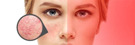 Light therapy for rosacea - Red Light Man