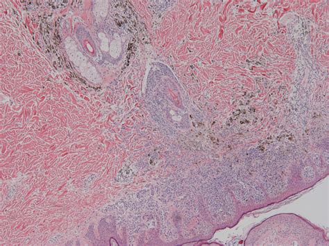 Pathology Outlines - Nevus with features of congenital onset