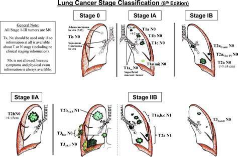 The Eighth Edition Lung Cancer Stage Classification - CHEST