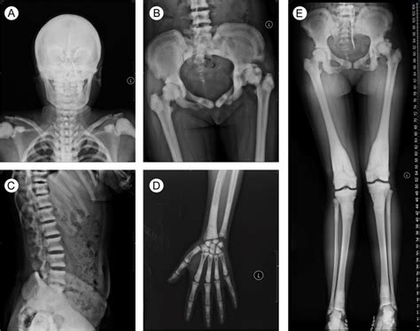 X-ray evaluation of an autosomal dominant osteopetrosis type 2 (ADO-2)... | Download Scientific ...