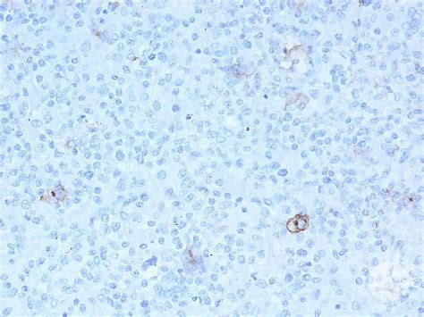 CD30 positive Reed- Sternberg cells