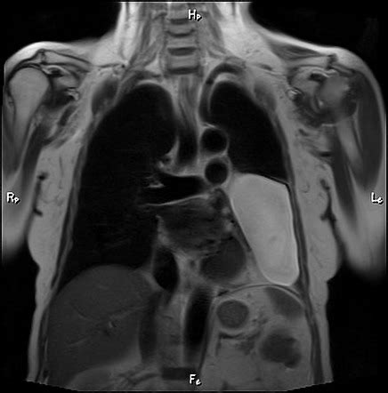 Pericardial cyst | Radiology Reference Article | Radiopaedia.org