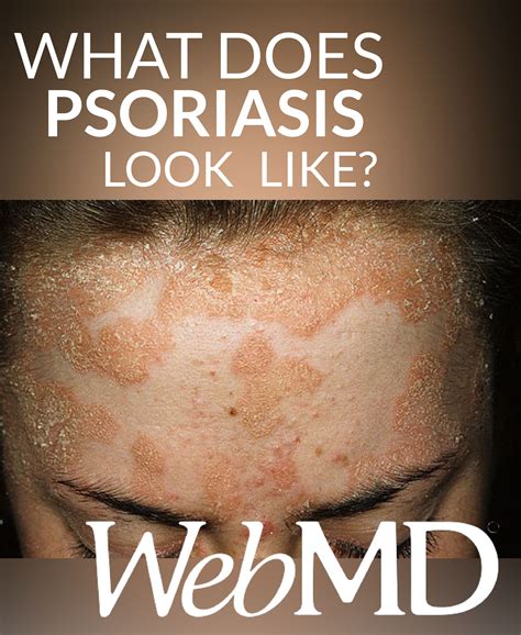 Pin on All About Psoriasis