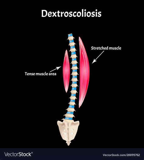 Scoliosis dextroscoliosis spinal curvature Vector Image