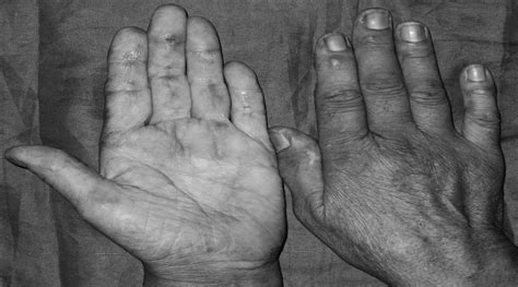 Palmar Gottron Papules and Gottron Sign : JCR: Journal of Clinical Rheumatology