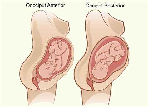 Causes Of Occiput Posterior Position And Management Tips | Posterior baby, Childbirth, Baby position