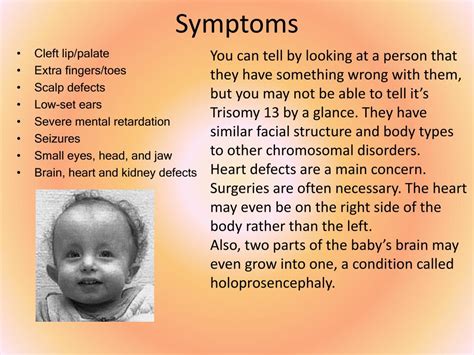 Edwards Syndrome Trisomy 18 Causes Symptoms And Types