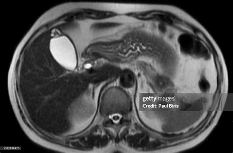 Adenomyomatosis Of The Gallbladder Axial T2 Mri Image High-Res Stock ...