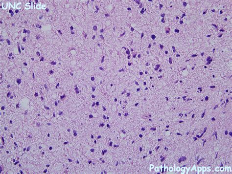 anaplastic astrocytoma brain histology