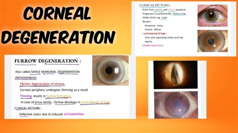 corneal degeneration |classification | symptoms | treatment ...