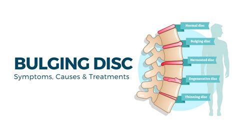 Bulging Disc | Symptoms, Causes & Treatments