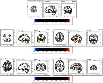 Frontiers | Anterior Cingulate Cortex Activity During Rest Is Related to Alterations in Pain ...