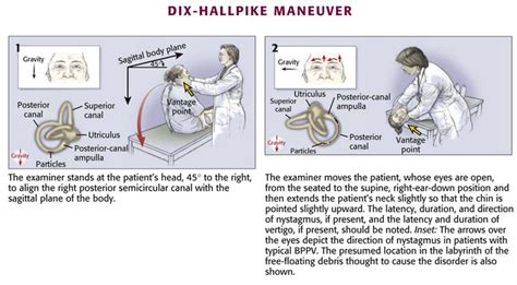 Vestibular examination : Dix-Hallpike Maneuver for BPPV | Epomedicine