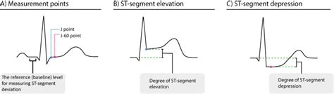 Figure 34. ST-segment deviation – ECG learning