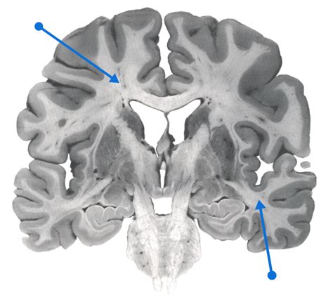 White matter - Neuromedia