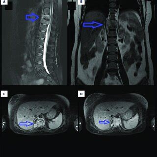 Figure A is the sagittal view of the preoperative thoracic spine MRI.... | Download Scientific ...